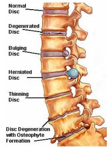 degenerative-disc-disease degenerative-disc-disease