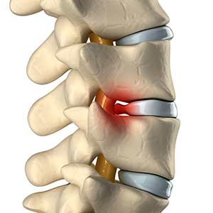 herniated-bulging-discs herniated