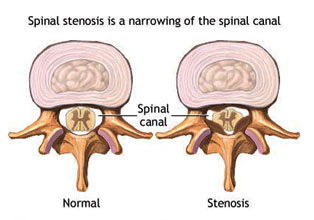 spinal-stenosis spinal-stenosis